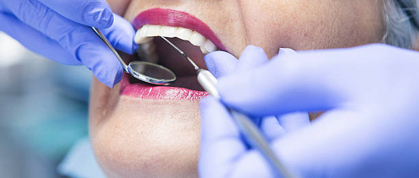 Best Knocked-Out Tooth (Avulsed Tooth) Treatment in Stonebridge, NJ